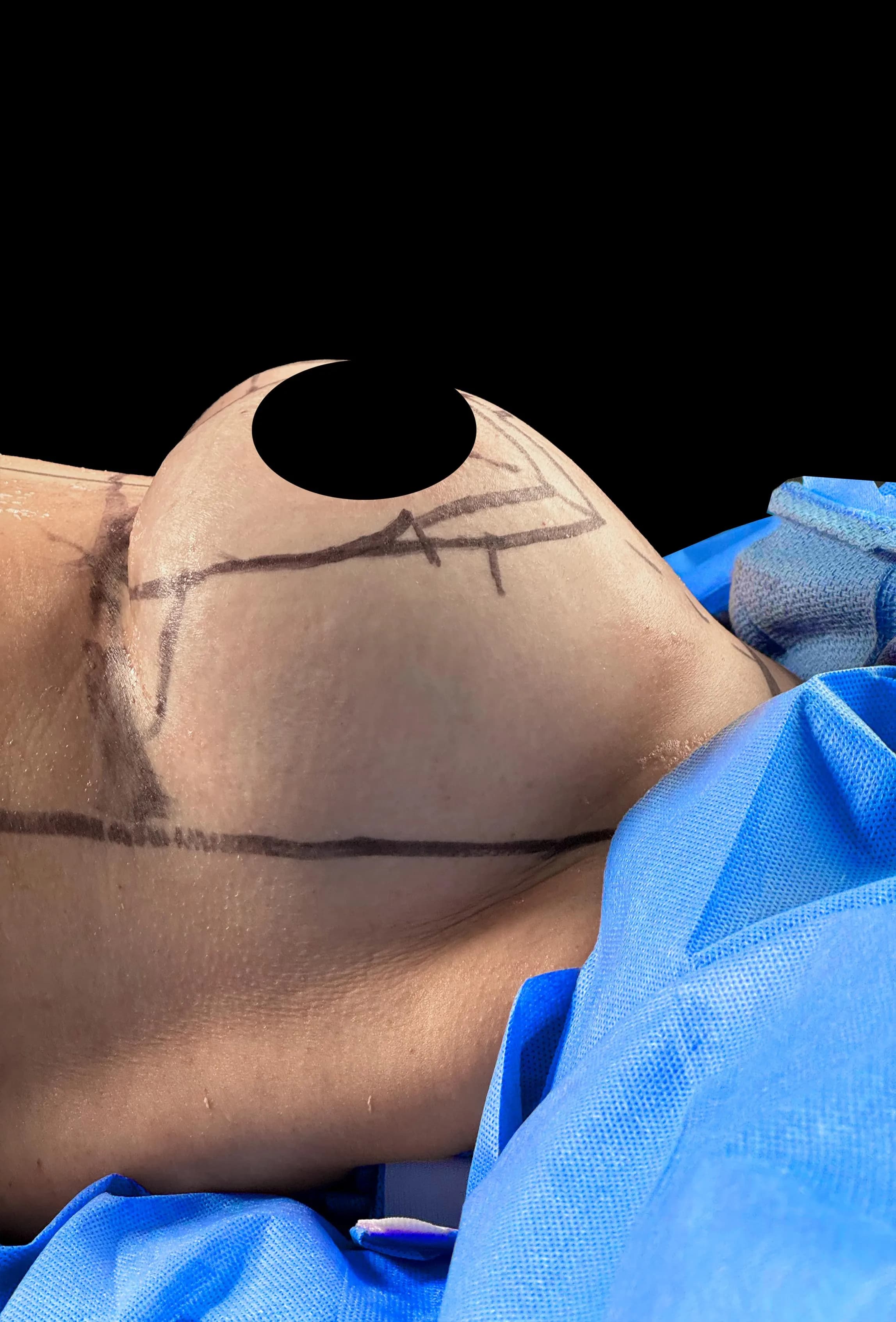 Breast Lift before by Dr. Anne-Sophie Lessard in Miami · Beautyland Plastic Surgery