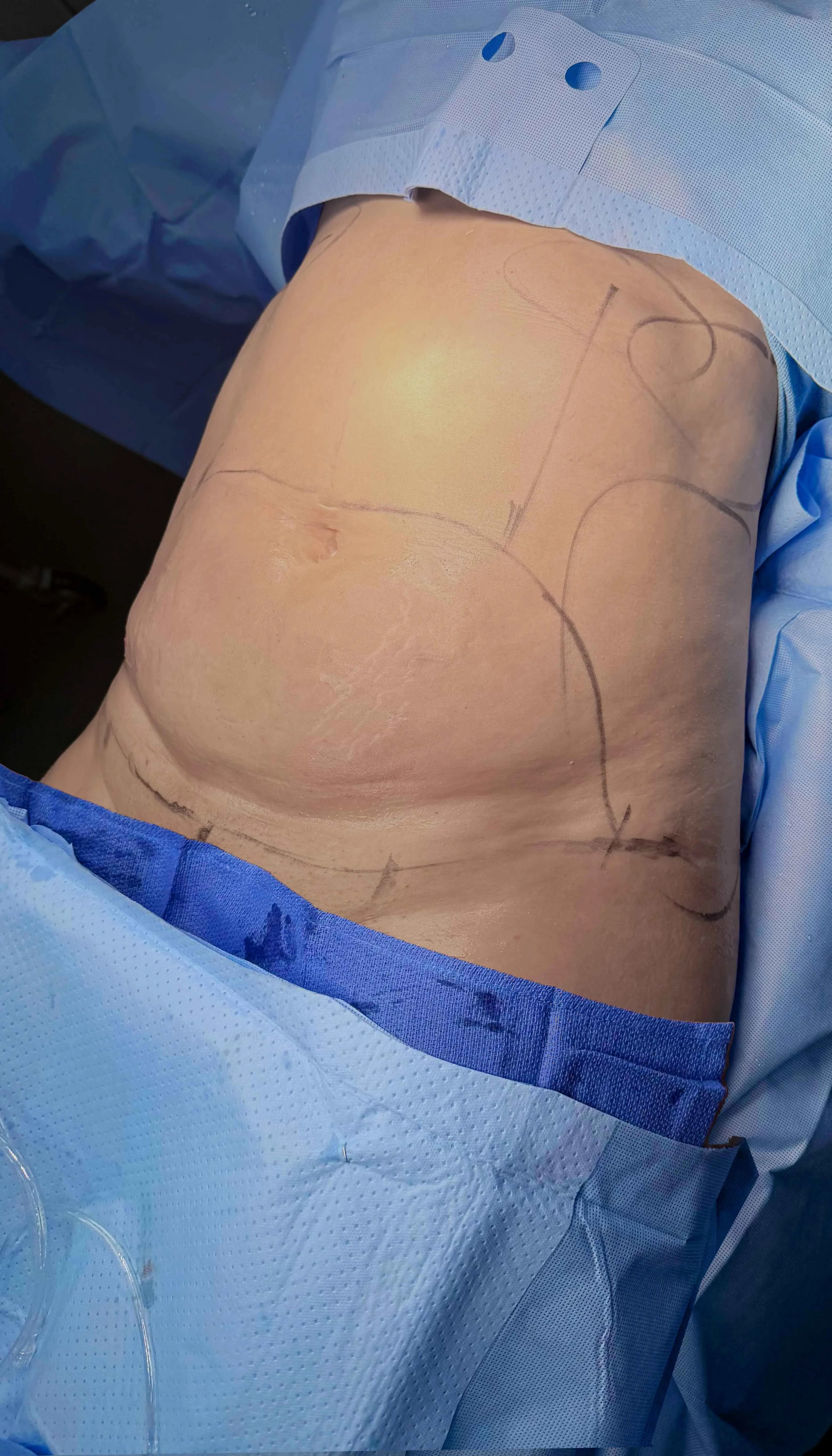 Abdominoplastia antes por Dr. Oliver Simmons en Miami · Beautyland Plastic Surgery
