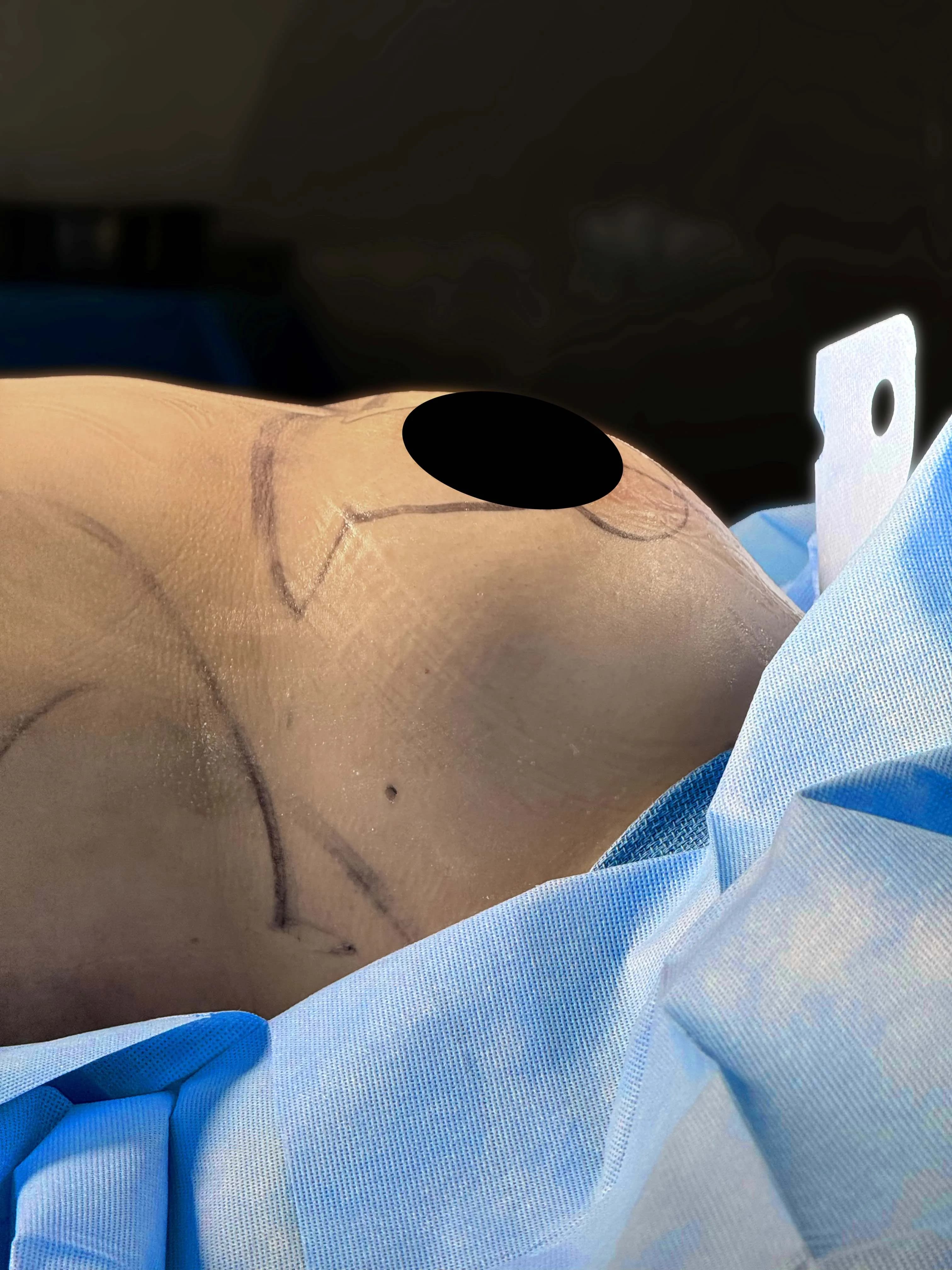 Breast Lift before · Dr. Anne-Sophie Lessard M.D, Miami