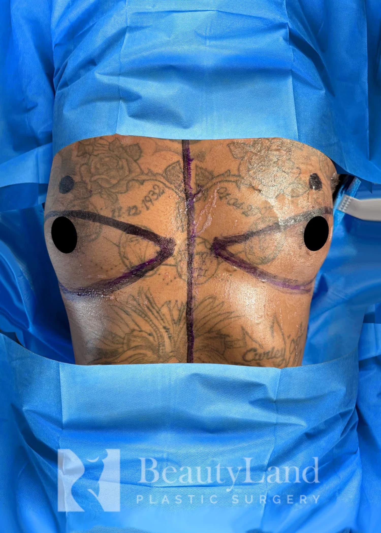 Reducción de senos antes por Dr. Christopher J. Salgado en Miami · Beautyland Plastic Surgery