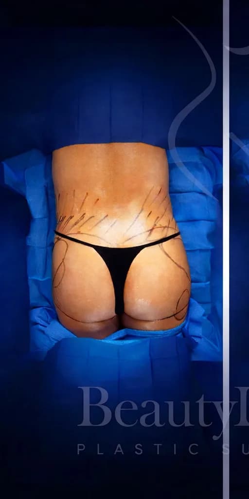 Aumento de glúteos BBL antes por Dr. Anne-Sophie Lessard en Miami · Beautyland Plastic Surgery