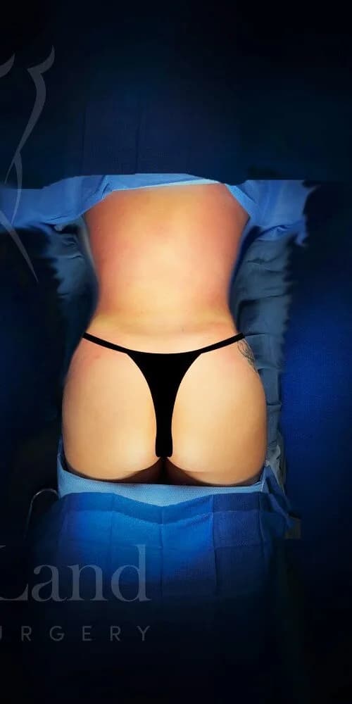 Aumento de glúteos BBL después por Dr. Anne-Sophie Lessard en Miami · Beautyland Plastic Surgery