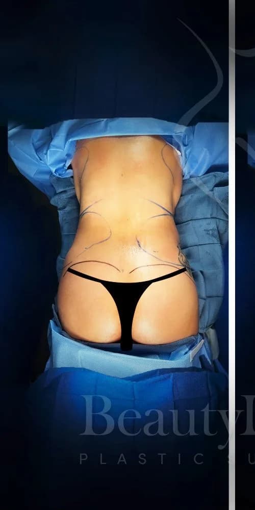 Aumento de glúteos BBL antes por Dr. Anne-Sophie Lessard en Miami · Beautyland Plastic Surgery
