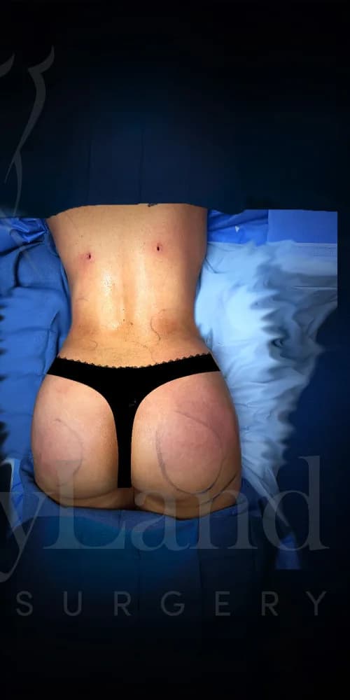Aumento de glúteos BBL después por Dr. Anne-Sophie Lessard en Miami · Beautyland Plastic Surgery