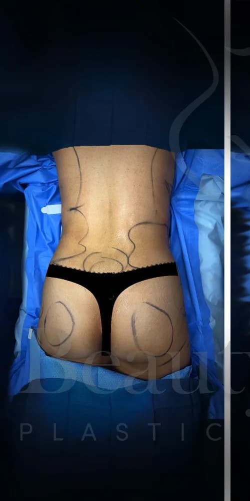 Aumento de glúteos BBL antes por Dr. Anne-Sophie Lessard en Miami · Beautyland Plastic Surgery