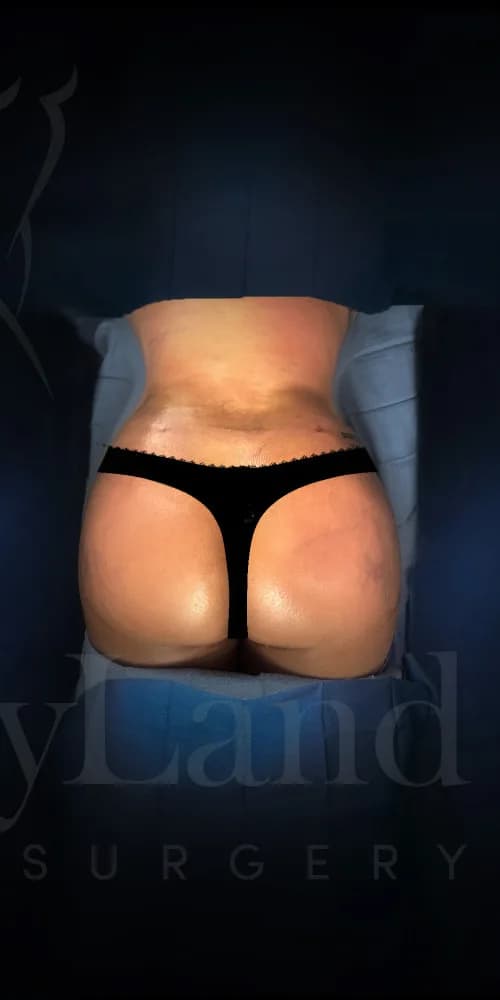 Aumento de glúteos BBL después por Dr. Anne-Sophie Lessard en Miami · Beautyland Plastic Surgery