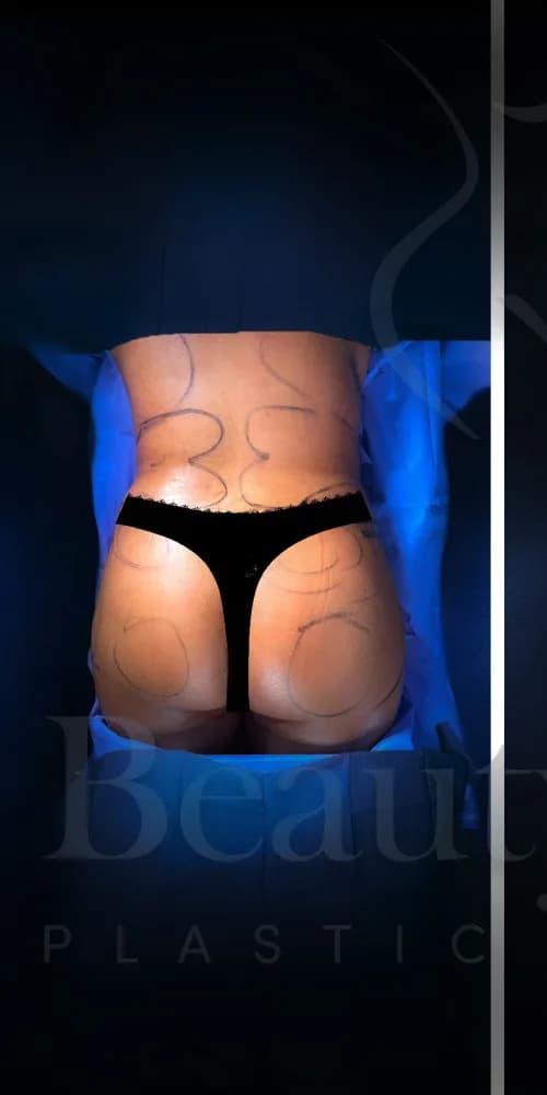 Aumento de glúteos BBL antes por Dr. Anne-Sophie Lessard en Miami · Beautyland Plastic Surgery