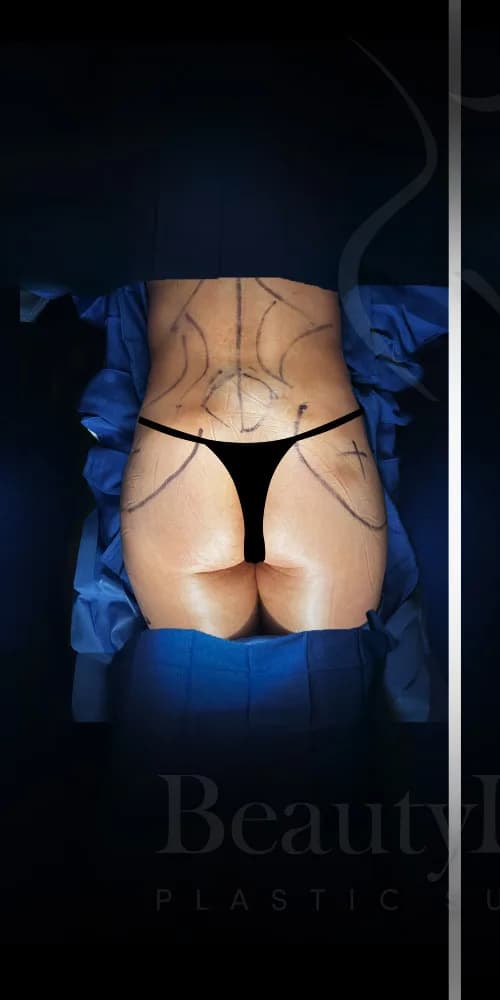 Aumento de glúteos BBL antes por Dr. Christopher J. Salgado en Miami · Beautyland Plastic Surgery