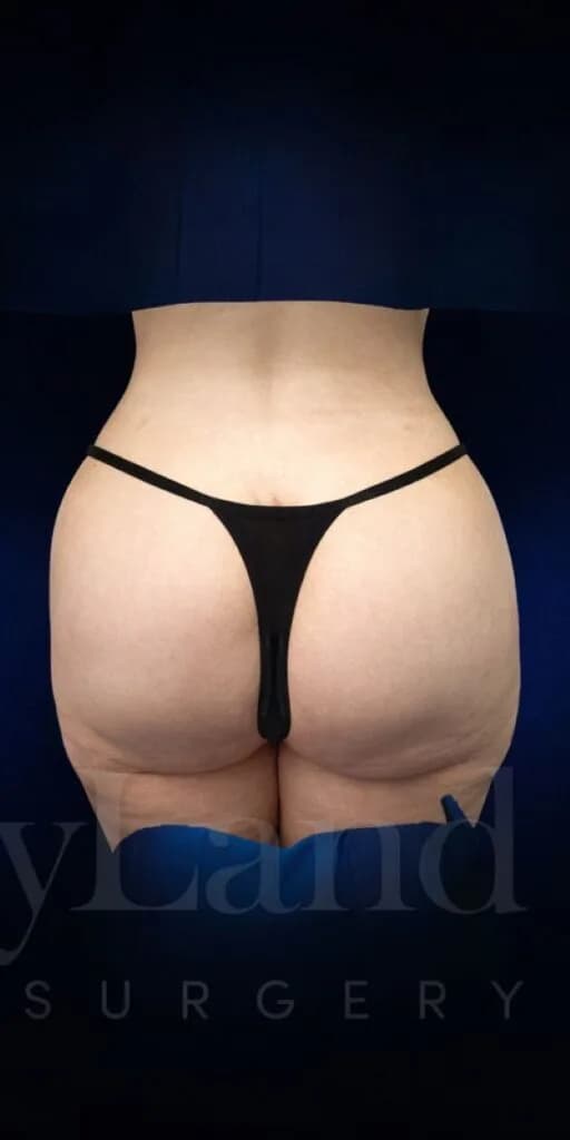 Implantes de glúteos después por Dr. Christopher J. Salgado en Miami · Beautyland Plastic Surgery