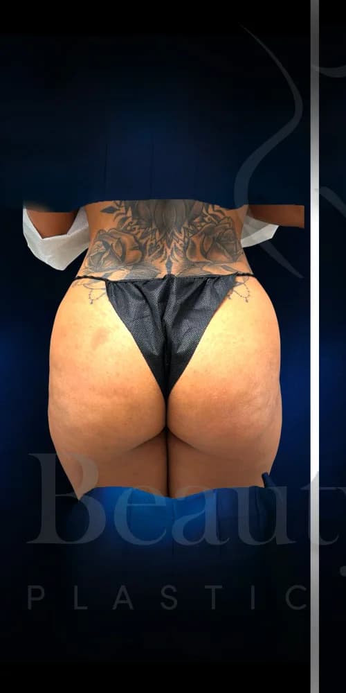 Implantes de glúteos antes por Dr. Christopher J. Salgado en Miami · Beautyland Plastic Surgery