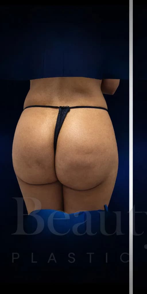 Implantes de glúteos antes por Dr. Christopher J. Salgado en Miami · Beautyland Plastic Surgery