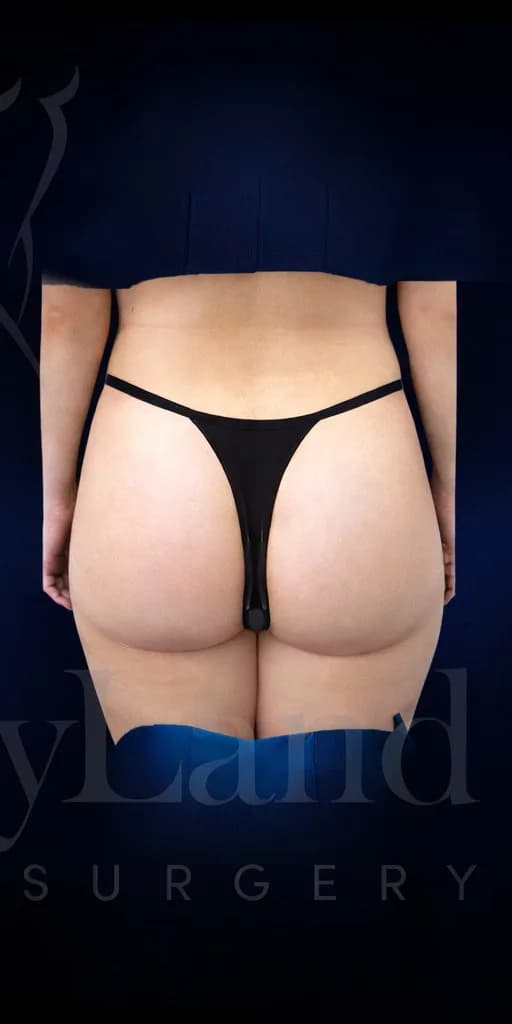 Implantes de glúteos después por Dr. Christopher J. Salgado en Miami · Beautyland Plastic Surgery