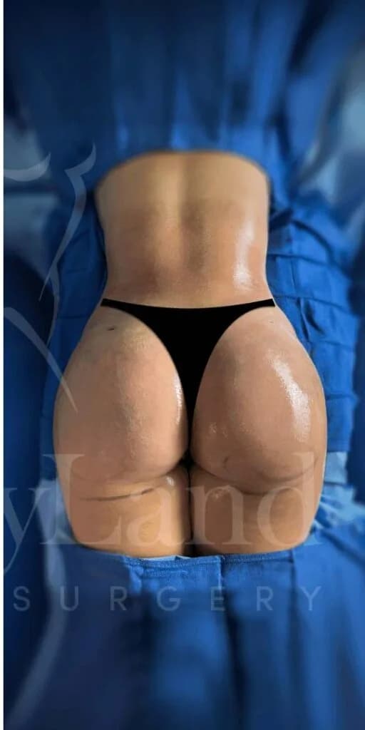 Aumento de glúteos BBL después por Dr. Oliver Simmons en Miami · Beautyland Plastic Surgery