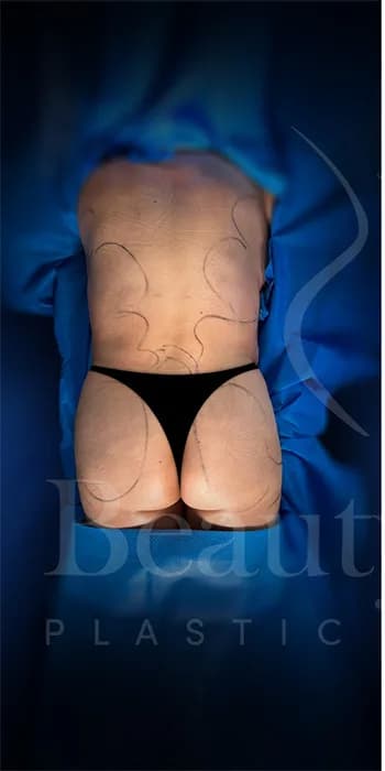 Aumento de glúteos BBL antes por Dr. Oliver Simmons en Miami · Beautyland Plastic Surgery