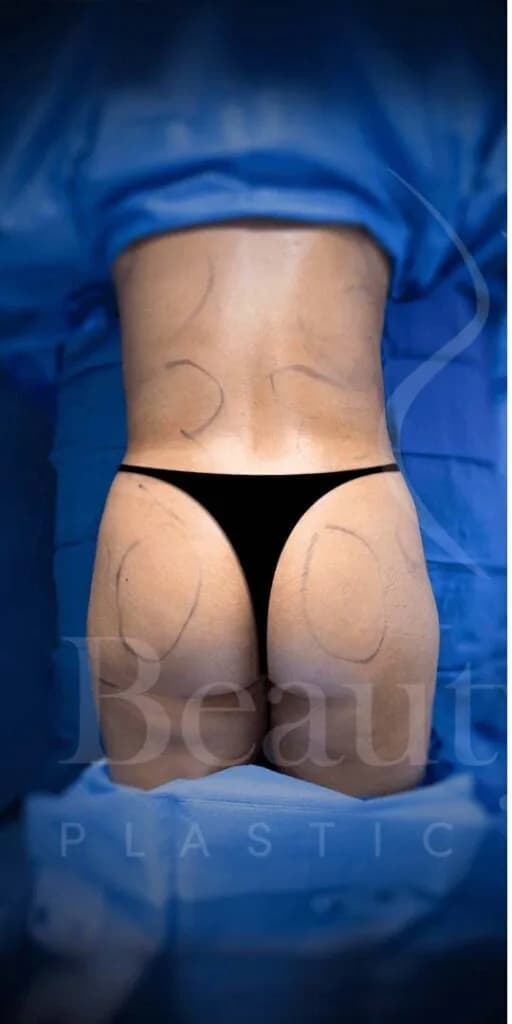 Aumento de glúteos BBL antes por Dr. Oliver Simmons en Miami · Beautyland Plastic Surgery