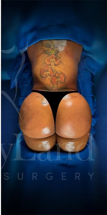 Aumento de glúteos BBL después por Dr. Oliver Simmons en Miami · Beautyland Plastic Surgery