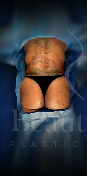 Aumento de glúteos BBL antes por Dr. Oliver Simmons en Miami · Beautyland Plastic Surgery