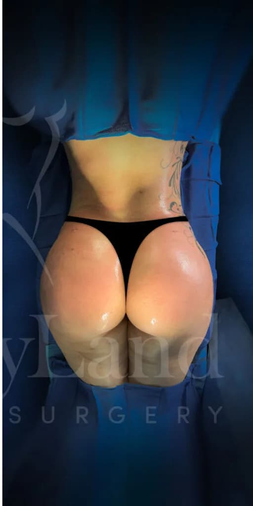 Aumento de glúteos BBL después por Dr. Oliver Simmons en Miami · Beautyland Plastic Surgery