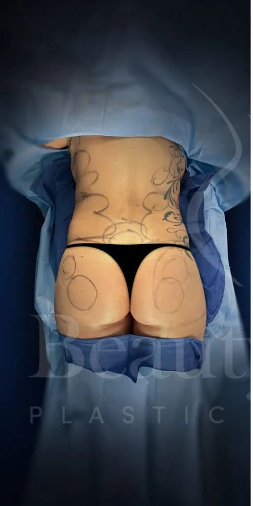 Aumento de glúteos BBL antes por Dr. Oliver Simmons en Miami · Beautyland Plastic Surgery