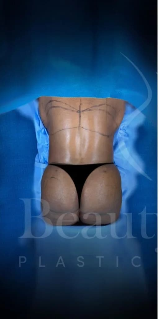 Aumento de glúteos BBL antes por Dr. Oliver Simmons en Miami · Beautyland Plastic Surgery