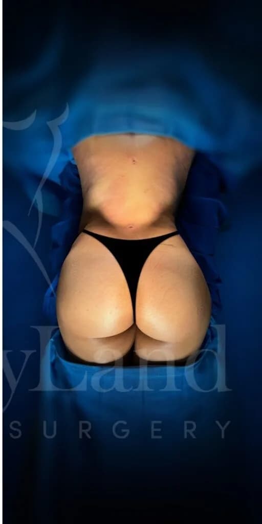 Aumento de glúteos BBL después por Dr. Oliver Simmons en Miami · Beautyland Plastic Surgery