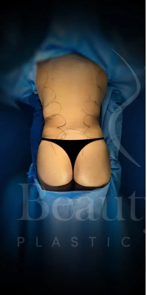 Aumento de glúteos BBL antes por Dr. Oliver Simmons en Miami · Beautyland Plastic Surgery