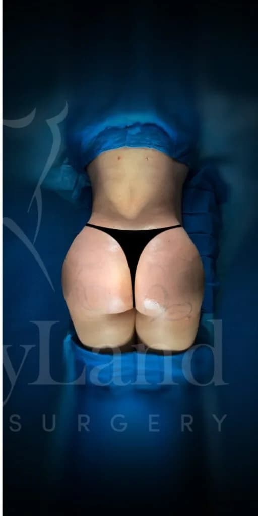 Aumento de glúteos BBL después por Dr. Oliver Simmons en Miami · Beautyland Plastic Surgery