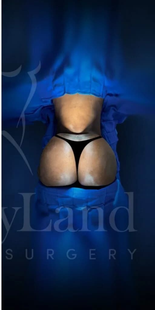 Aumento de glúteos BBL después por Dr. Oliver Simmons en Miami · Beautyland Plastic Surgery