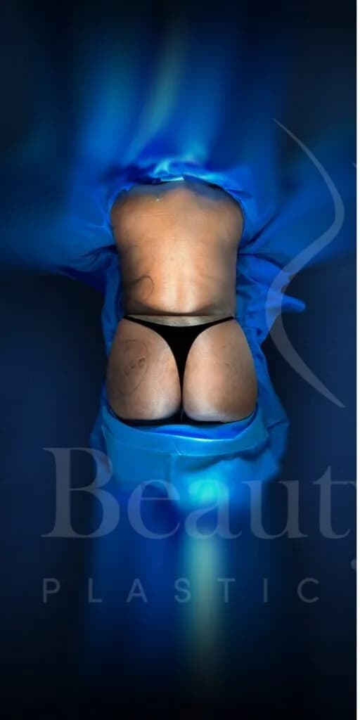 Aumento de glúteos BBL antes por Dr. Oliver Simmons en Miami · Beautyland Plastic Surgery