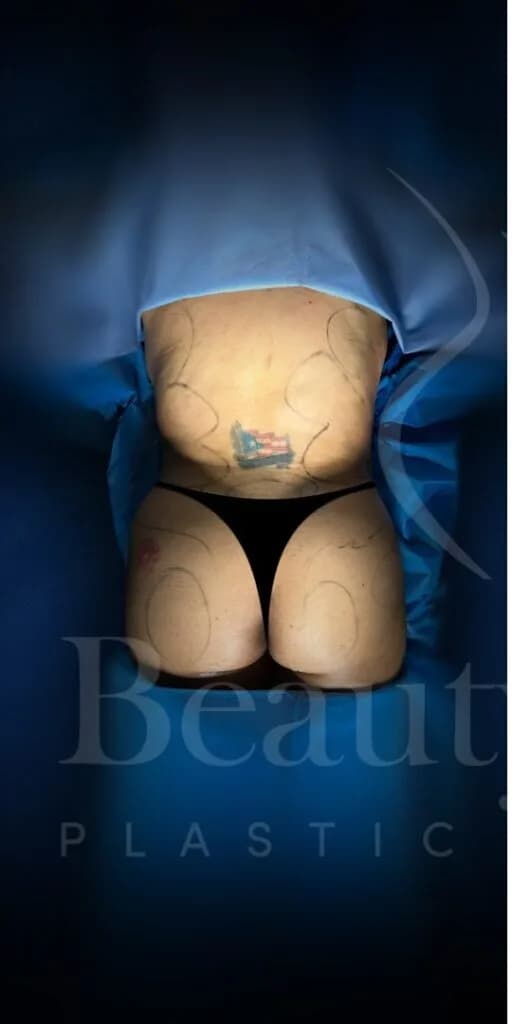 Aumento de glúteos BBL antes por Dr. Oliver Simmons en Miami · Beautyland Plastic Surgery