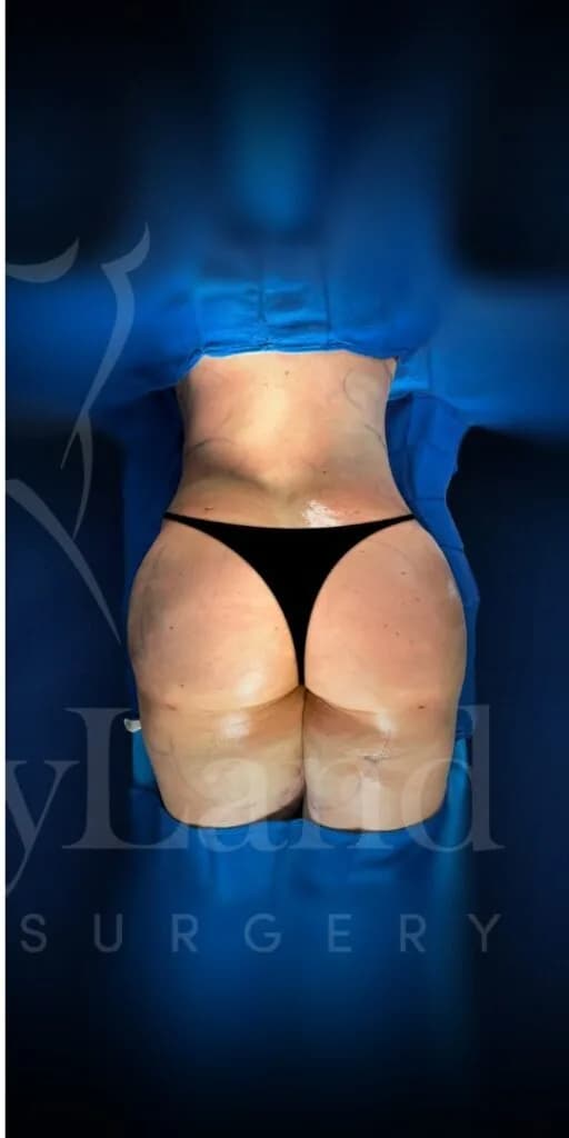 Aumento de glúteos BBL después por Dr. Oliver Simmons en Miami · Beautyland Plastic Surgery