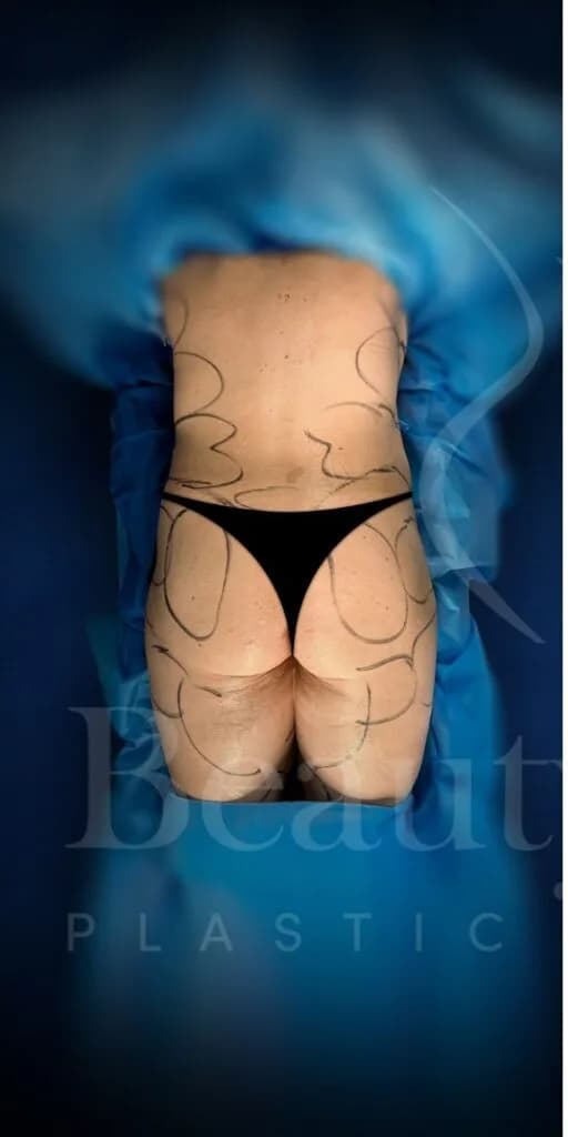 Aumento de glúteos BBL antes por Dr. Oliver Simmons en Miami · Beautyland Plastic Surgery