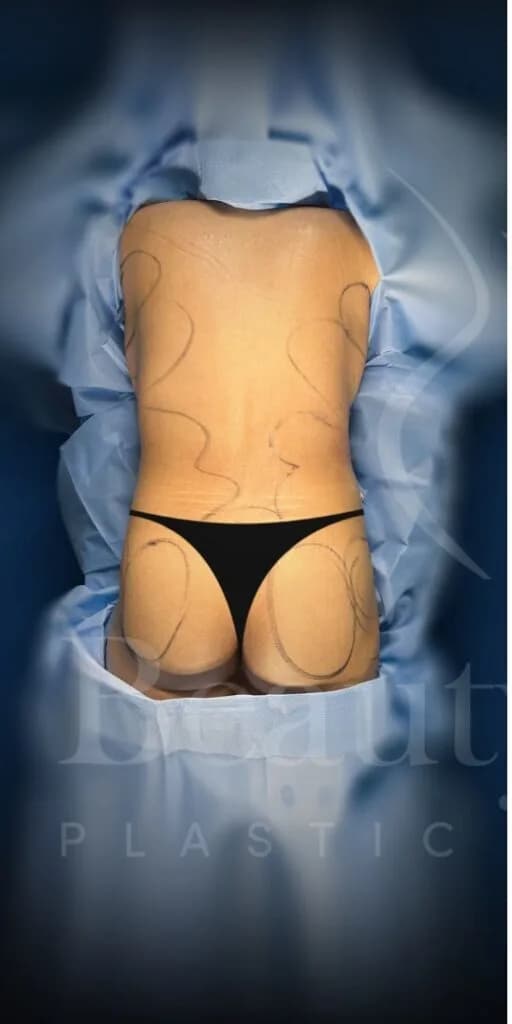 Aumento de glúteos BBL antes por Dr. Oliver Simmons en Miami · Beautyland Plastic Surgery