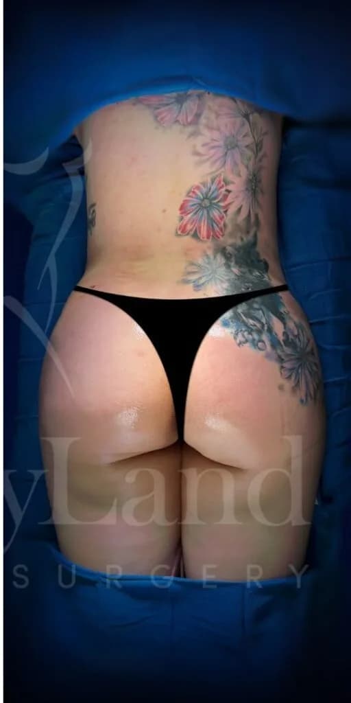 Aumento de glúteos BBL después por Dr. Oliver Simmons en Miami · Beautyland Plastic Surgery