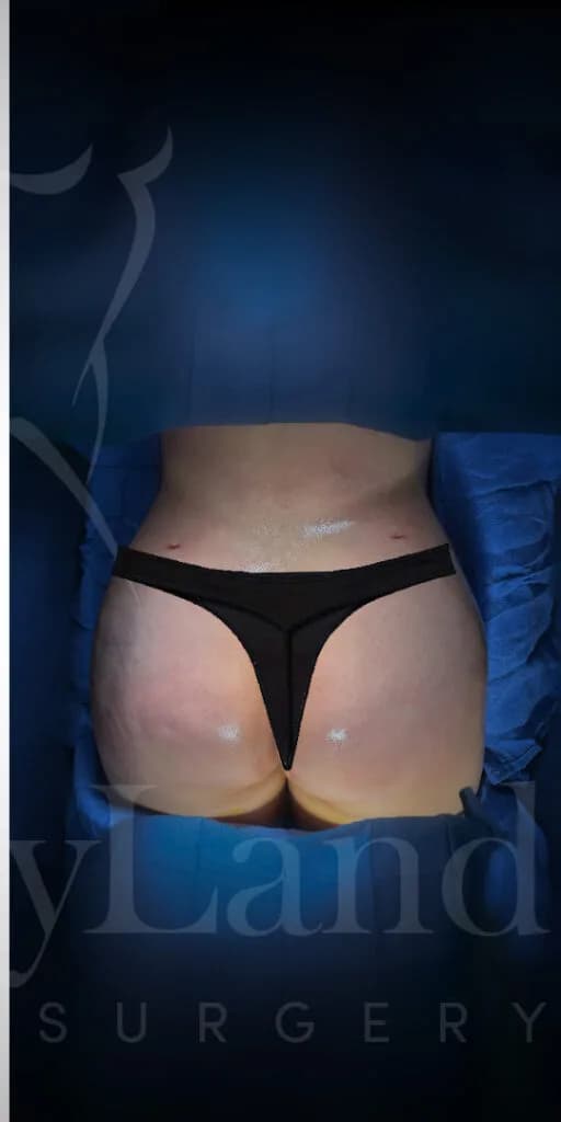 Aumento de glúteos BBL después por Dr. Oliver Simmons en Miami · Beautyland Plastic Surgery