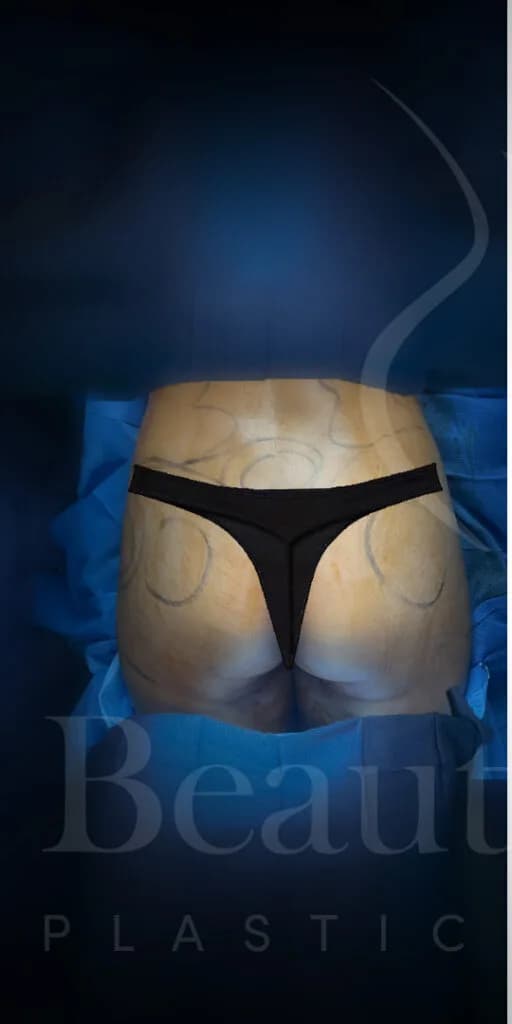 Aumento de glúteos BBL antes por Dr. Oliver Simmons en Miami · Beautyland Plastic Surgery