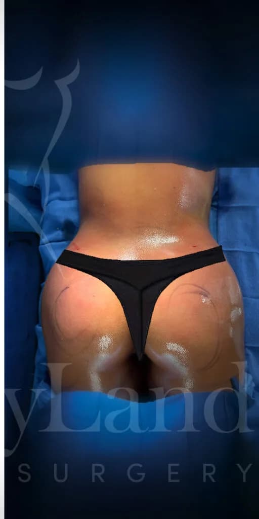 Aumento de glúteos BBL después por Dr. Oliver Simmons en Miami · Beautyland Plastic Surgery