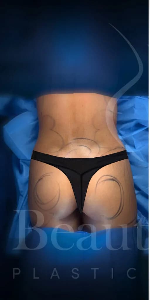 Aumento de glúteos BBL antes por Dr. Oliver Simmons en Miami · Beautyland Plastic Surgery