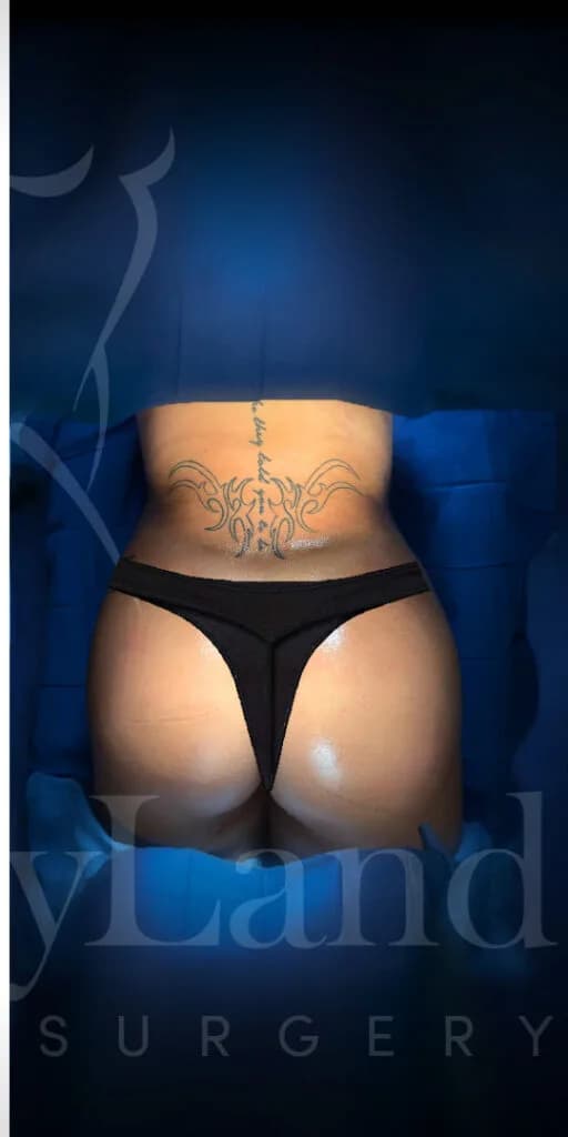 Aumento de glúteos BBL después por Dr. Oliver Simmons en Miami · Beautyland Plastic Surgery