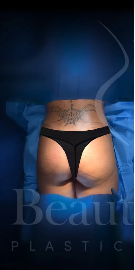 Aumento de glúteos BBL antes por Dr. Oliver Simmons en Miami · Beautyland Plastic Surgery