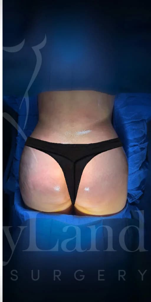 Aumento de glúteos BBL después por Dr. Oliver Simmons en Miami · Beautyland Plastic Surgery