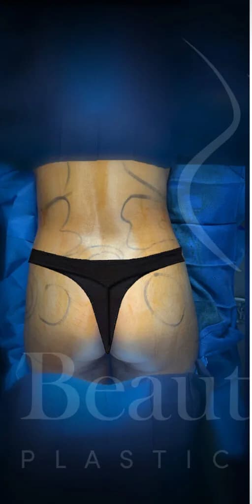 Aumento de glúteos BBL antes por Dr. Oliver Simmons en Miami · Beautyland Plastic Surgery