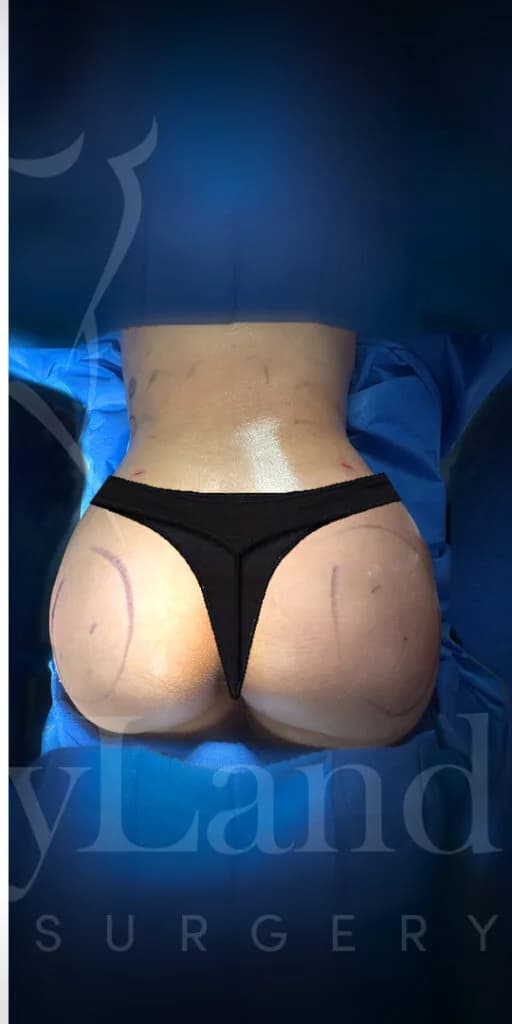 Aumento de glúteos BBL después por Dr. Oliver Simmons en Miami · Beautyland Plastic Surgery