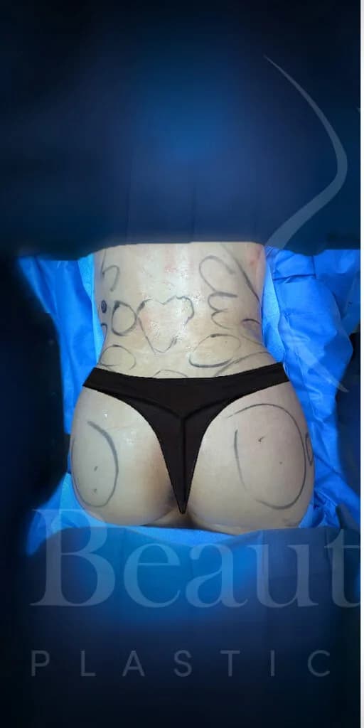 Aumento de glúteos BBL antes por Dr. Oliver Simmons en Miami · Beautyland Plastic Surgery