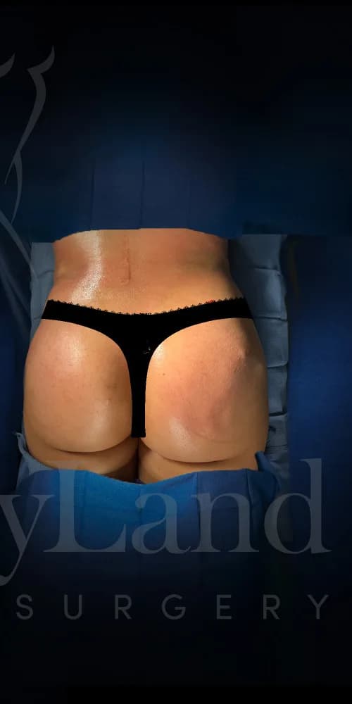 Aumento de glúteos BBL después por Dr. Oliver Simmons en Miami · Beautyland Plastic Surgery