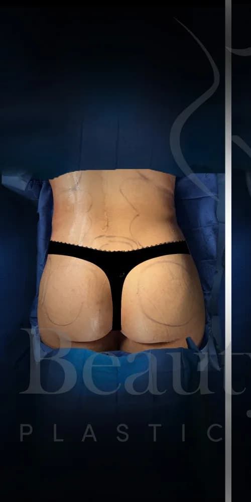 Aumento de glúteos BBL antes por Dr. Oliver Simmons en Miami · Beautyland Plastic Surgery