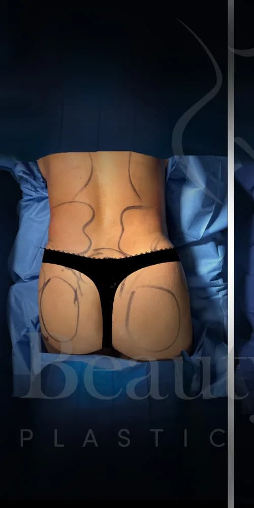 Aumento de glúteos BBL antes por Dr. Oliver Simmons en Miami · Beautyland Plastic Surgery