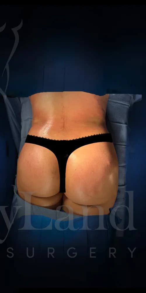 Aumento de glúteos BBL después por Dr. Oliver Simmons en Miami · Beautyland Plastic Surgery