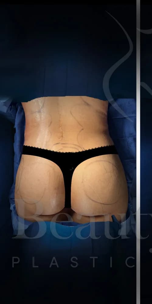 Aumento de glúteos BBL antes por Dr. Oliver Simmons en Miami · Beautyland Plastic Surgery
