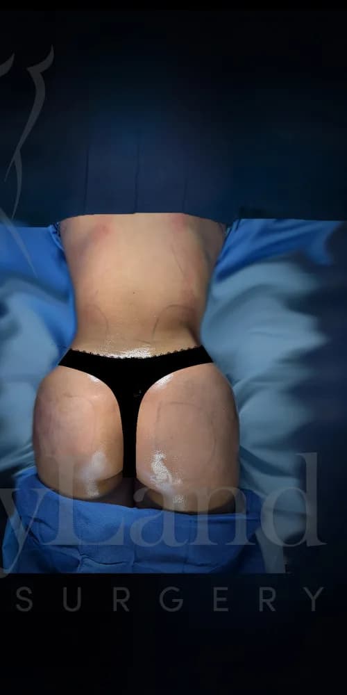 Aumento de glúteos BBL después por Dr. Oliver Simmons en Miami · Beautyland Plastic Surgery